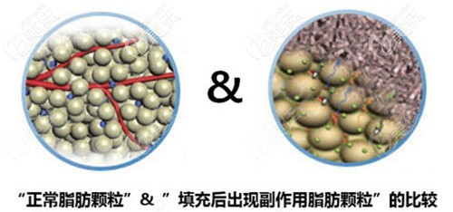 脂肪填充过量脂肪形成硬结团块示意图