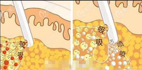 面部吸脂脂肪修复术介绍
