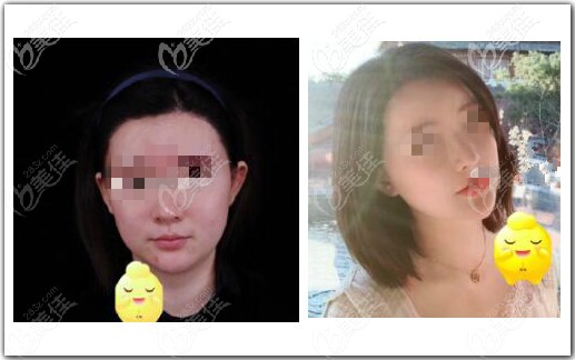 面部吸脂脂肪修复术真人案例效果