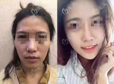 面颊局部脂肪填充过量修复效果图