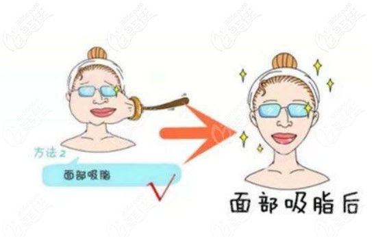 面部吸脂前后对比照片 面部吸脂前后对比照片