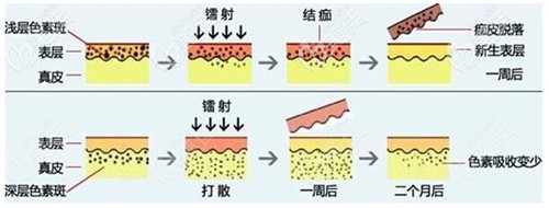 白瓷娃娃去去黄褐斑的原理