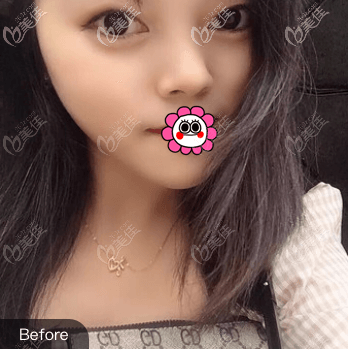 我找北京画美徐学东做双眼皮前 我找北京画美徐学东做双眼皮前