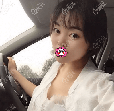 做眼睛好的徐学东医生给我做双眼皮第7天 做眼睛好的徐学东医生给我做双眼皮第7天