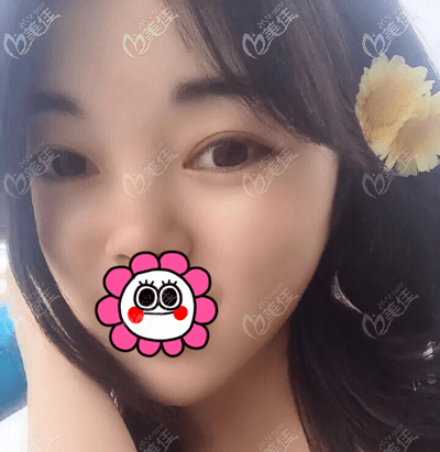 北京画美徐学东医生给我做双眼皮半个月<span style= 北京画美徐学东医生给我做双眼皮半个月<span style=