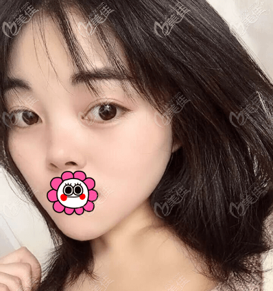 徐学东医生在哪家医院?得知他在北京画美医院就做了双眼皮这是45天<span style= 徐学东医生在哪家医院?得知他在北京画美医院就做了双眼皮这是45天<span style=