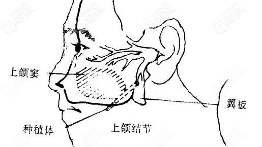 上颌翼板区种植技术