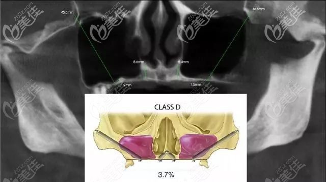 举例：顾客术前口腔的评估结果