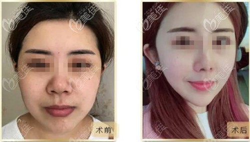 兰州韩美面部脂肪填充对比案例