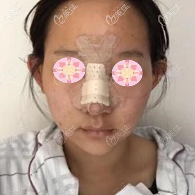 假体隆鼻术后第2天