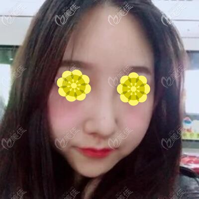 假体隆鼻半个月恢复照