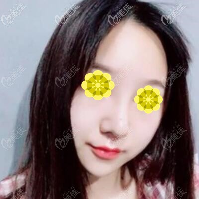 假体隆鼻1个月时的效果照