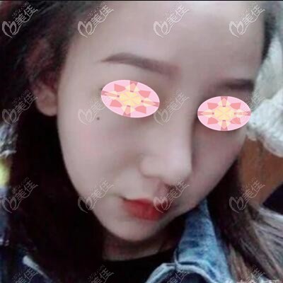 做假体隆鼻2个月时的效果照