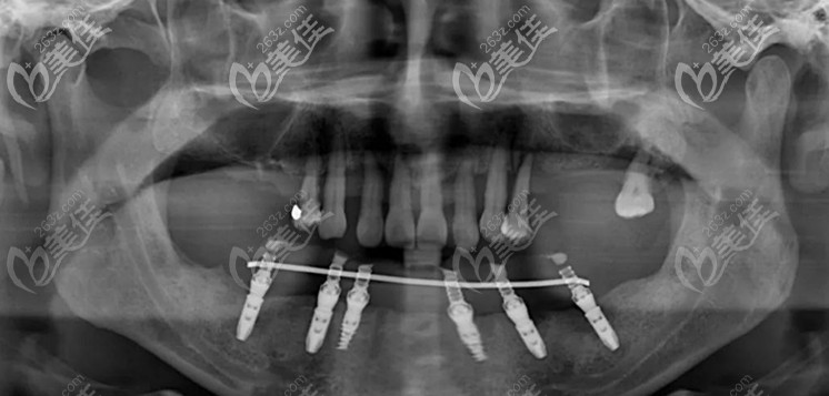 下颌通过植入6颗种植牙恢复半口