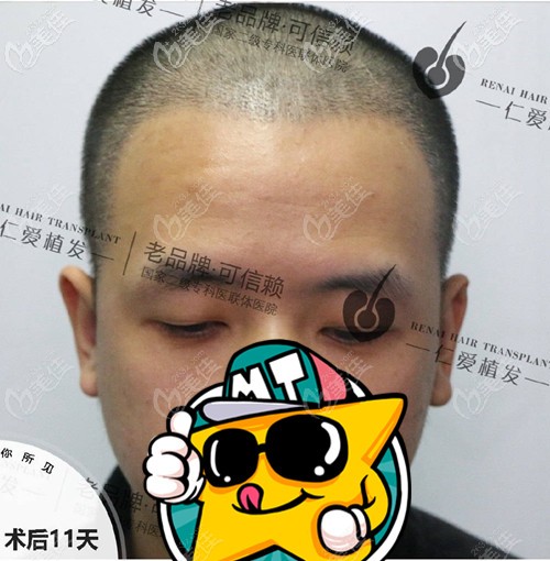 发际线种植术后11天效果图