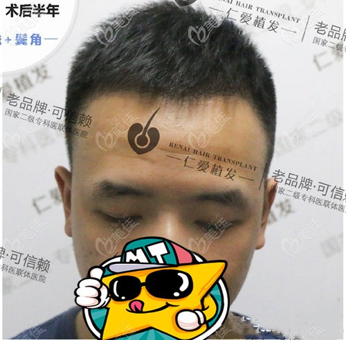 你们猜我在做的m发际线植发一次多少钱?顺便展示下种植1000个毛囊面积图片