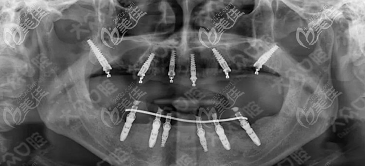 重度牙周病人的种植牙历程:下半口即刻种植+上半口穿翼板VIIV种植,长出全口牙不是梦