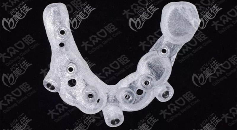 打印完成的上颌种植导板 打印完成的上颌种植导板