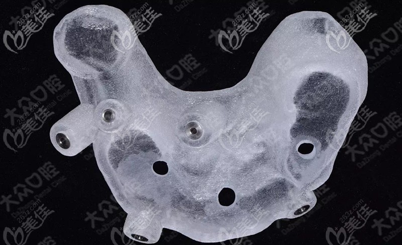 这是打印完的下颌骨种植导板 这是打印完的下颌骨种植导板