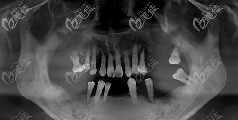 顾客种植前的口腔照 顾客种植前的口腔照