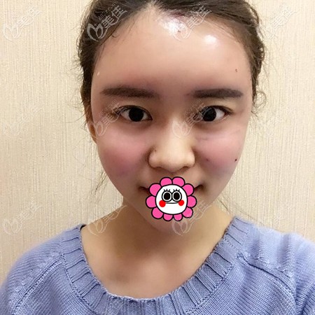 面部脂肪填充后脸有点肿