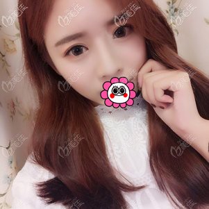 面部脂肪填充恢复两个月案例