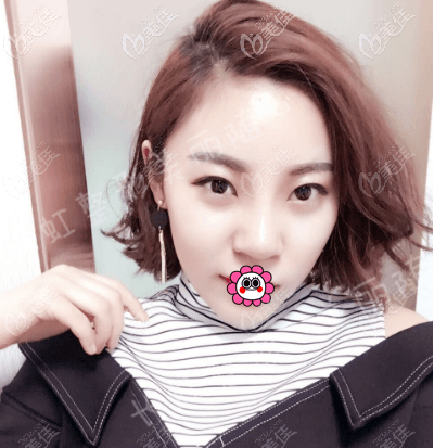 徐学东给我做隆鼻第10天了