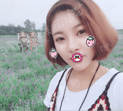 徐学东做鼻子如何？我在北京画美找他做鼻综合隆鼻48天<span style=