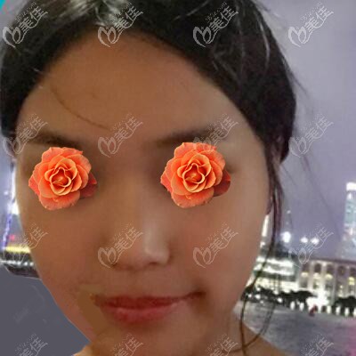 做肋软骨鼻综合术前照 做肋软骨鼻综合术前照