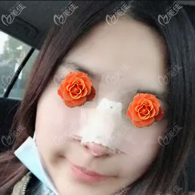 肋软骨鼻综合术后第3天照 肋软骨鼻综合术后第3天照