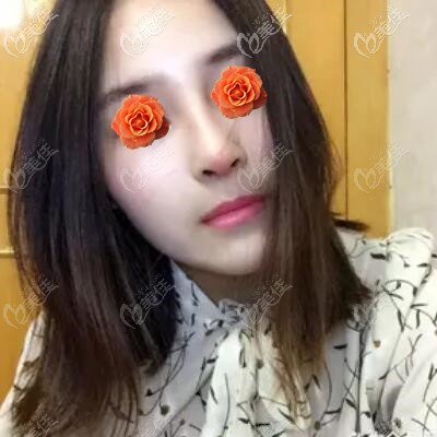 做肋软骨鼻综合术后10天恢复照 做肋软骨鼻综合术后10天恢复照