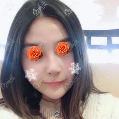 做肋软骨鼻综合术后1个月恢复照 做肋软骨鼻综合术后1个月恢复照