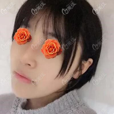 做肋软骨鼻综合术后2个月恢复效果照 做肋软骨鼻综合术后2个月恢复效果照