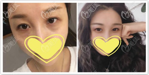 激光热熔祛眼袋恢复一个月效果对比图