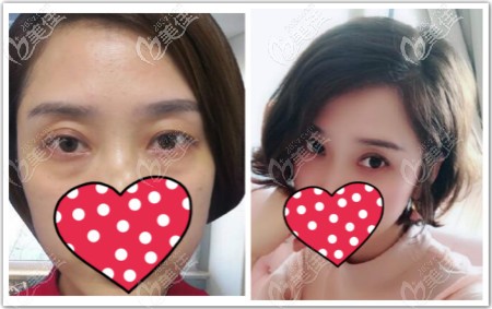 超声波祛眼袋三个月效果图