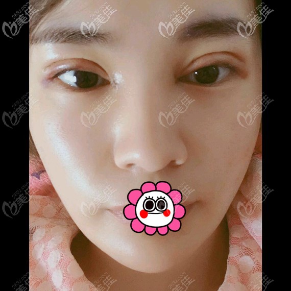 双眼皮术后恢复2天肿胀厉害