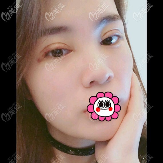 术后7天拆线后双眼皮恢复情况