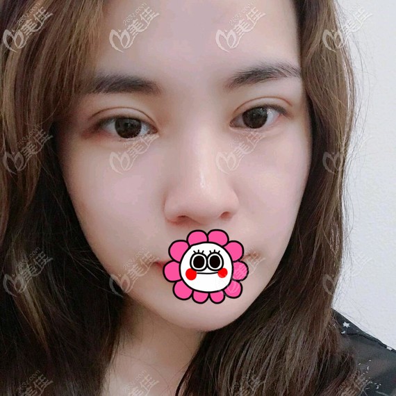 双眼皮恢复一个月线条流畅