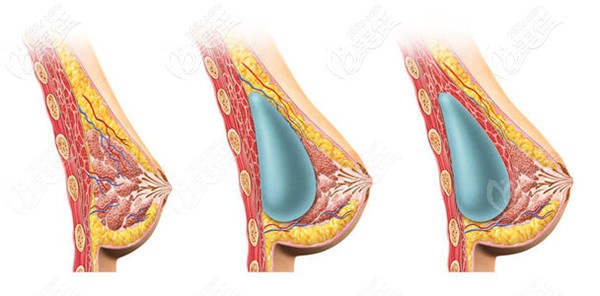 做假体隆胸手术 做假体隆胸手术