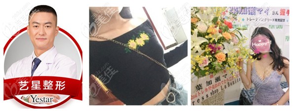 宁波艺星做隆胸手术实例 宁波艺星做隆胸手术实例