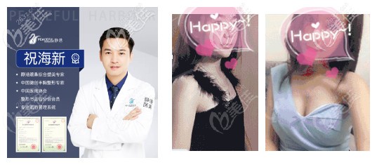 宁波静港做隆胸实例 宁波静港做隆胸实例