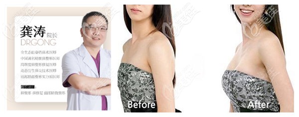 宁波<i data-id='dad92877-5779-44d2-90dd-2438c6ee1bdf' style='display:none;'></i>医院做隆胸手术疗效对比 宁波<i data-id='dad92877-5779-44d2-90dd-2438c6ee1bdf' style='display:none;'></i>医院做隆胸手术疗效对比