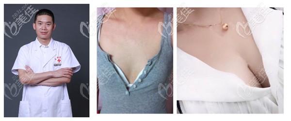 宁波江北尚丽医疗美容门诊部隆胸实例 宁波江北尚丽医疗美容门诊部隆胸实例