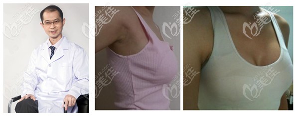徐建国美容整形做隆胸手术实例 徐建国美容整形做隆胸手术实例