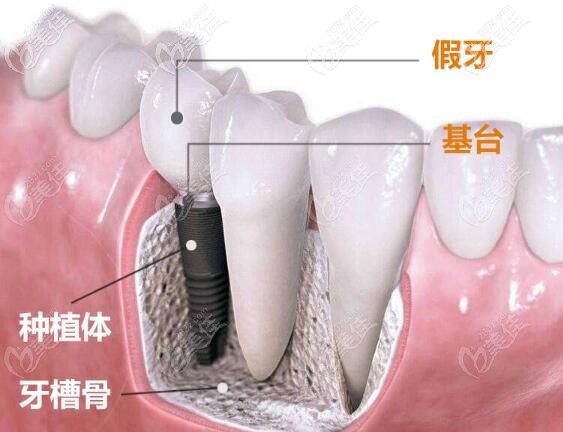 种植牙结构图