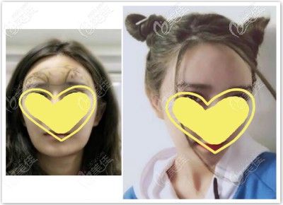 额头脂肪填充过量做皮层光焊脂肪修复术三个月效果图片 额头脂肪填充过量做皮层光焊脂肪修复术三个月效果图片