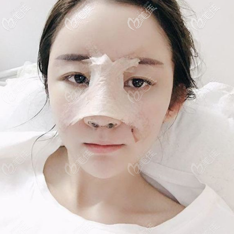 做完鼻综合隆鼻5天恢复期效果图