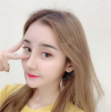 很满意佛山美莱王燕医生给我做的鼻子啊