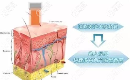 白瓷娃娃治疗原理