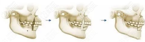 上下颌手术矫正 上下颌手术矫正